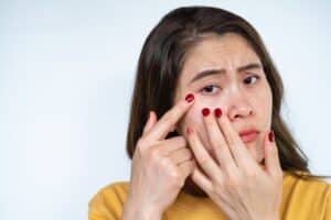 A woman looking at her acne scars and wondering about the benefits of SkinPen® microneedling
