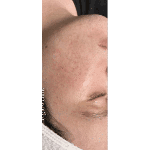 After Image: Acne Bootcamp