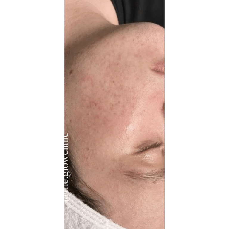 After Image: Acne Bootcamp - front