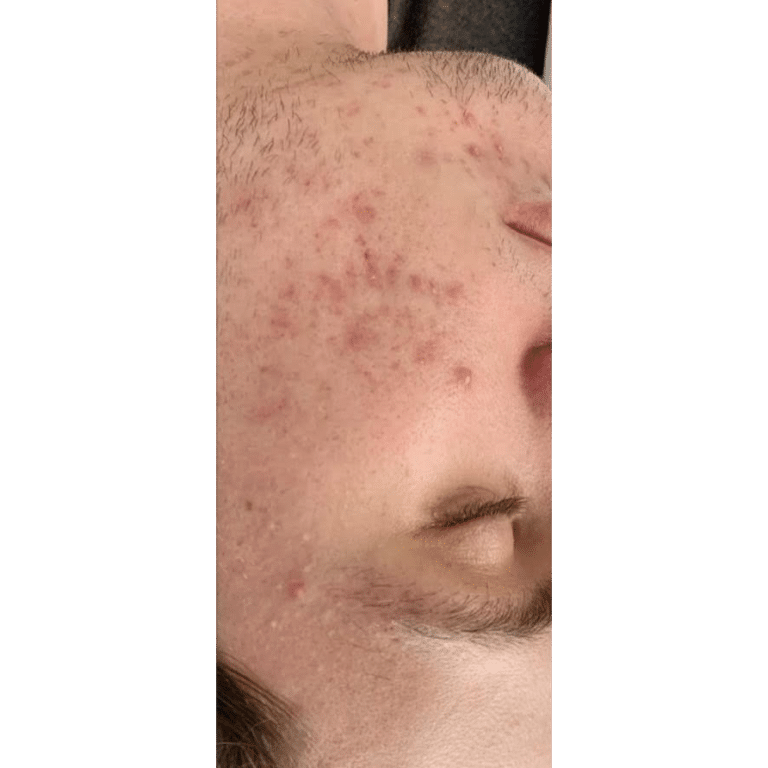 Before Image: Acne Bootcamp - front