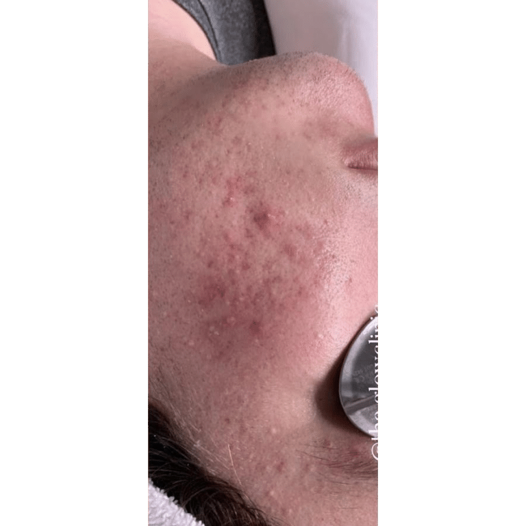 Before Image: Acne Bootcamp - front
