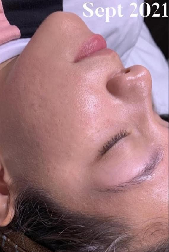 After Image: Acne Bootcamp - front