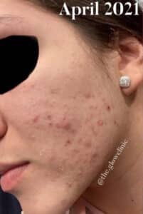 Before Image: Acne Bootcamp
