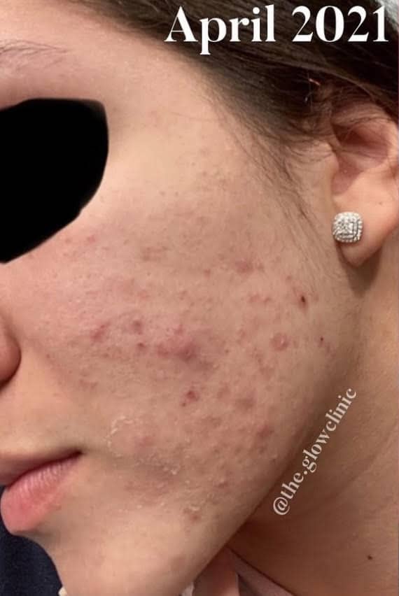 Before Image: Acne Bootcamp - front