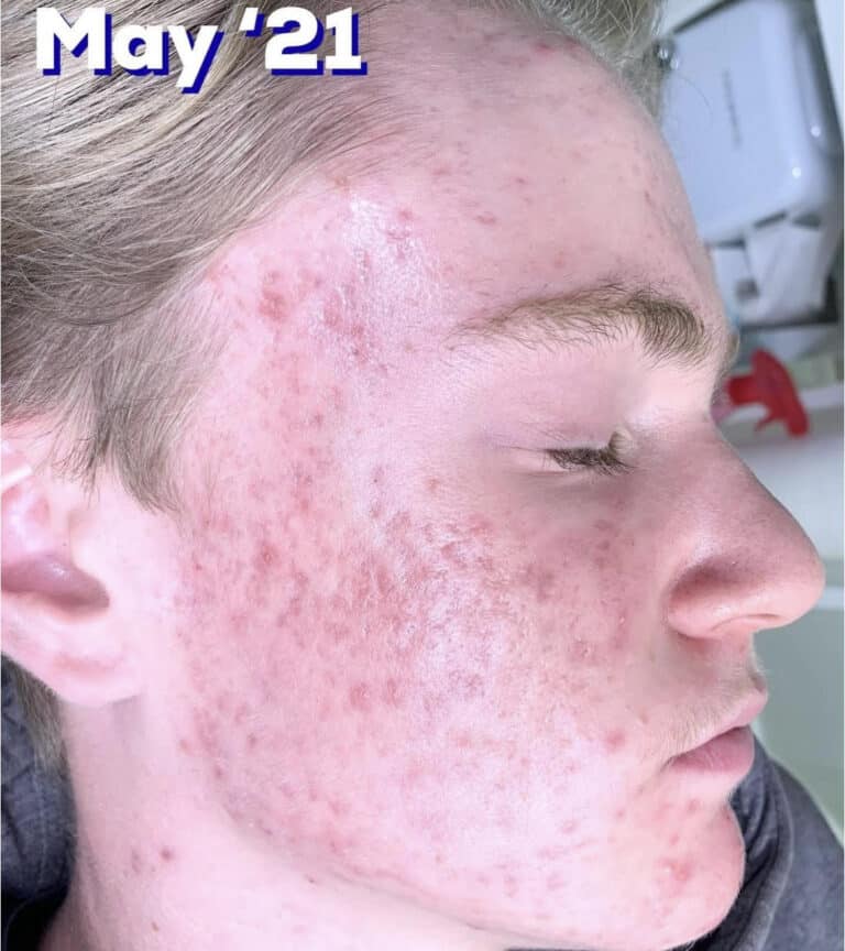 After Image: Acne Bootcamp - right-side