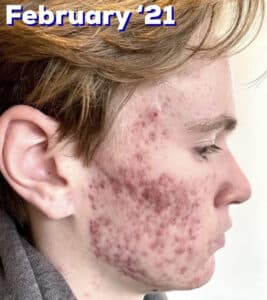 Before Image: Acne Bootcamp
