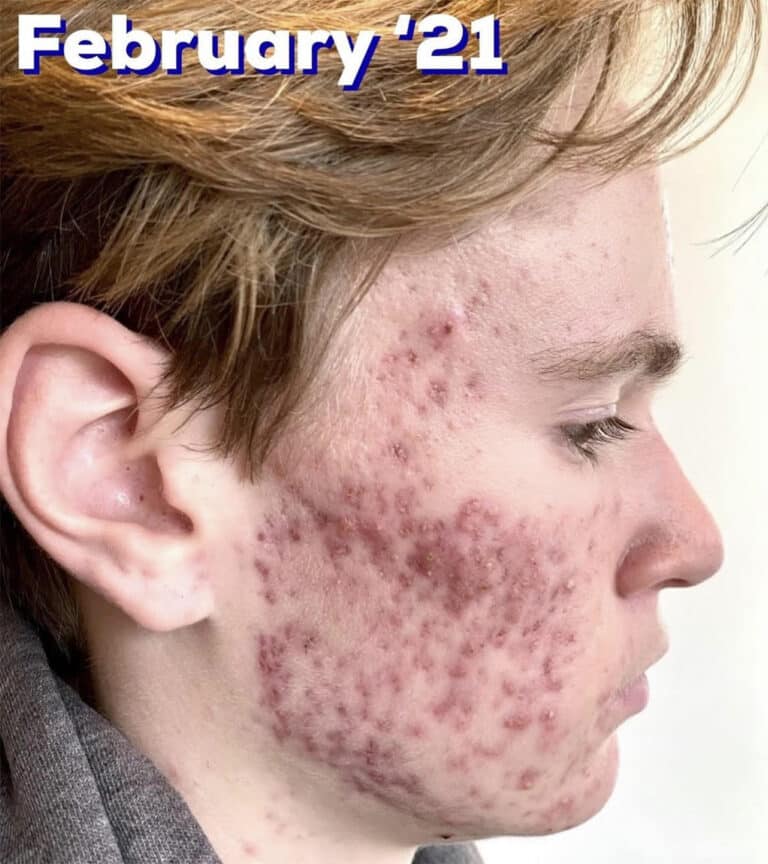 Before Image: Acne Bootcamp - right-side
