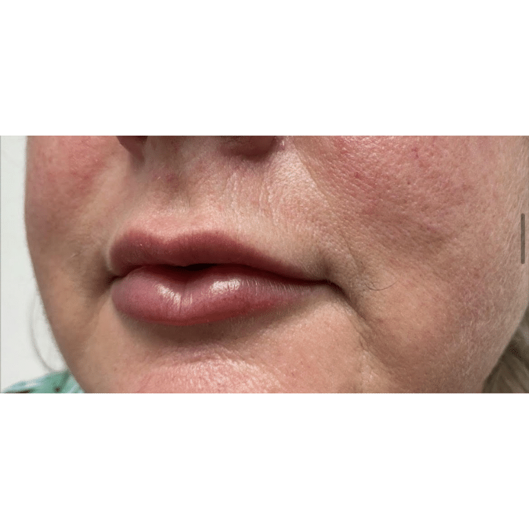 After Image: Lip Filler - left-front-oblique