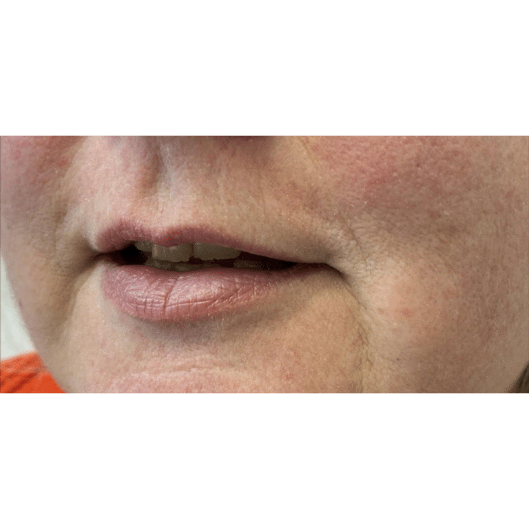 Before Image: Lip Filler - left-front-oblique