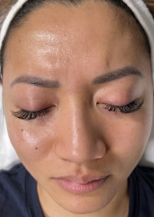 After Image: Perfect Derma Peel - front