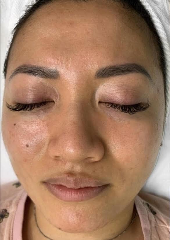 Before Image: Perfect Derma Peel - front