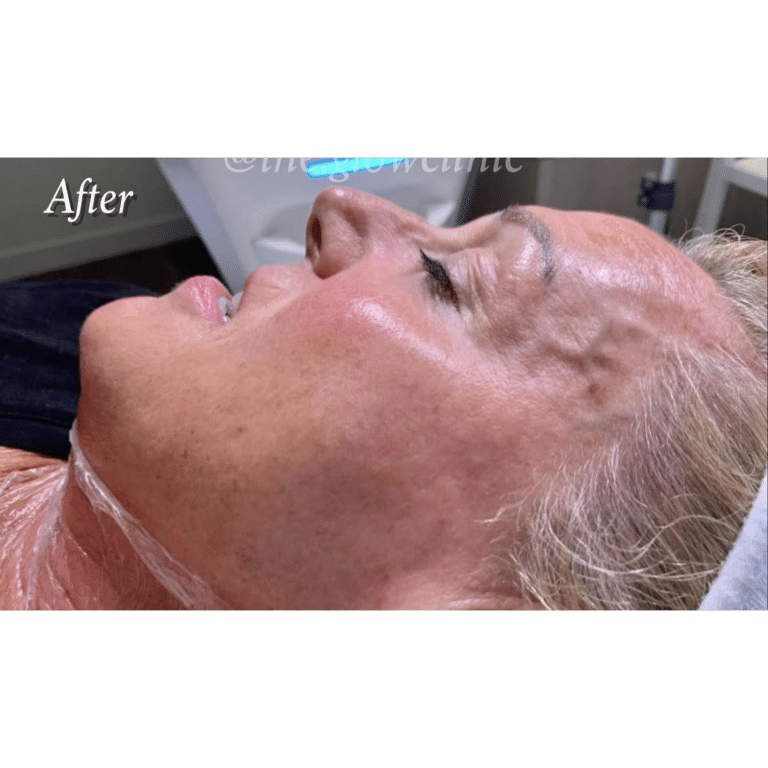 After Image: Radiofrequency Microneedling (Virtue RF) - front