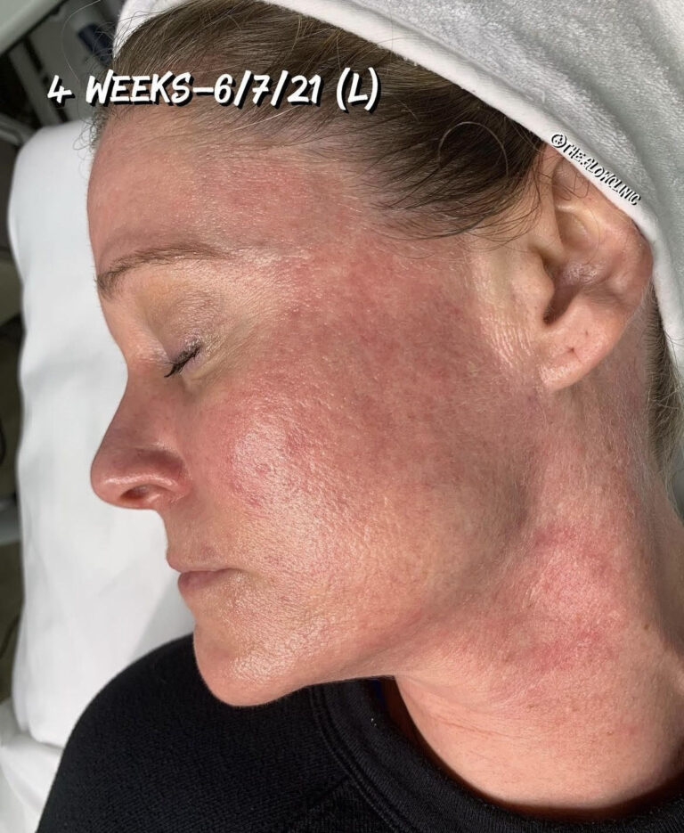 After Image: Red Carpet Glow Facial - left-front-oblique