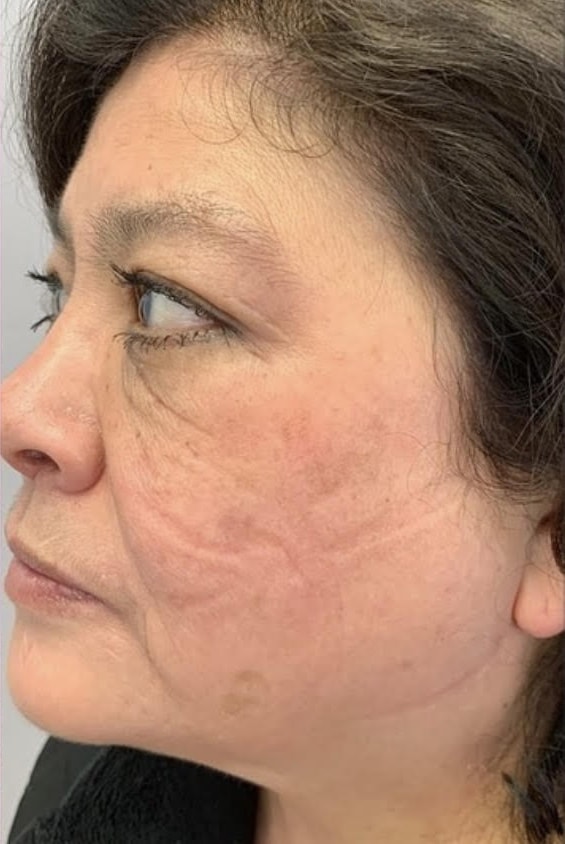 After Image: Hyperpigmentation Correction - left-side