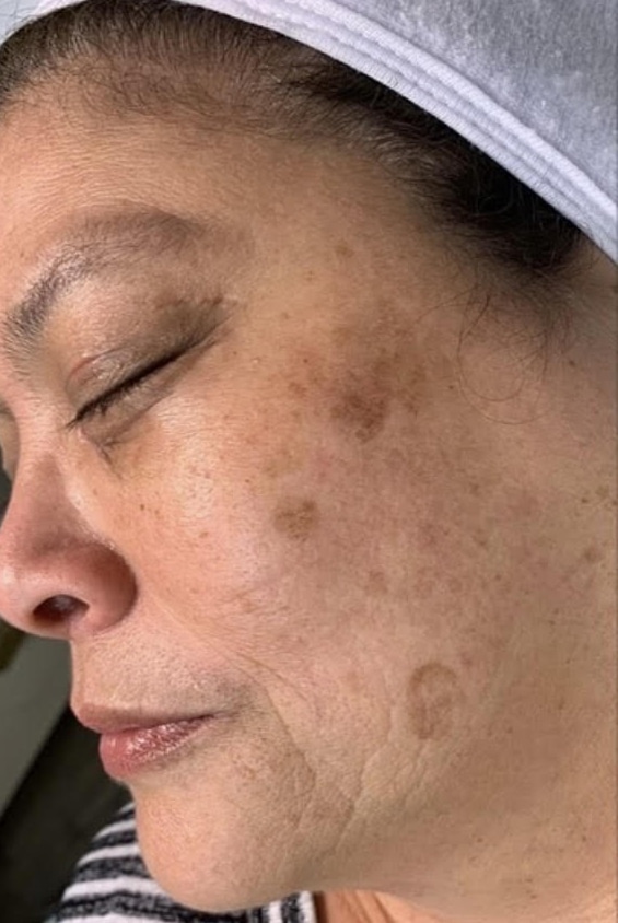 Before Image: Hyperpigmentation Correction - left-side