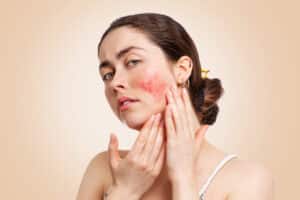 A woman with rosacea that could be managed with IPL treatment