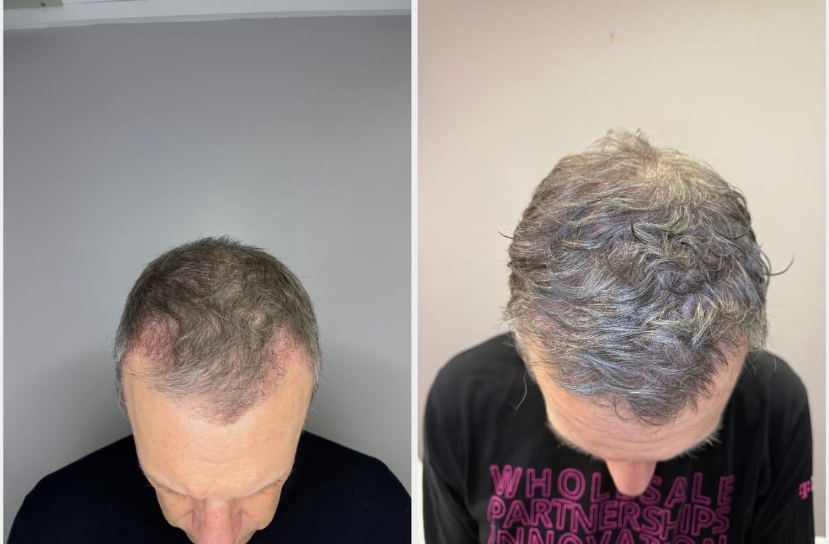 Greg L PRP Hair