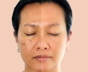 Woman with eyes closed, showing her skin before and after a brown spot treatment