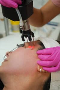 laser treatment 12
