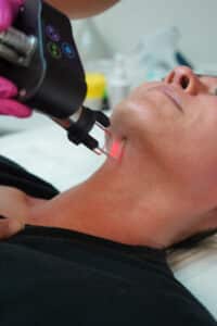 laser treatment 2