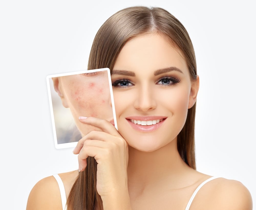 Woman with glowing skin holds a picture, showing her skin before acne scar treatment